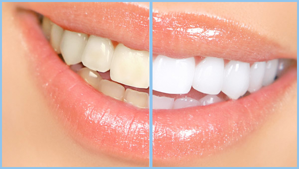 before-after-teeth-whitening